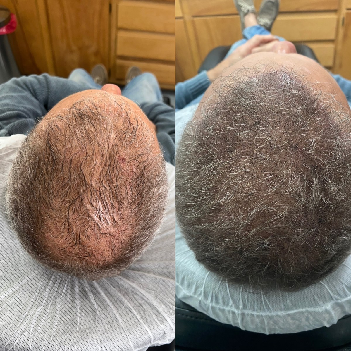 Scalp micropigmentation near me